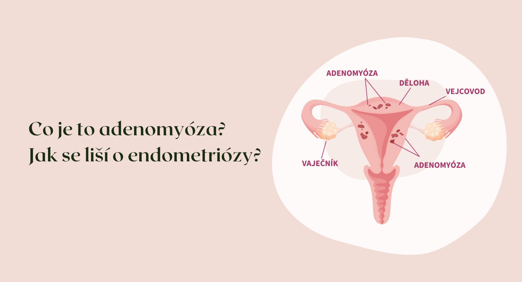 Co je to adenomyóza? Jak se liší o endometriózy?